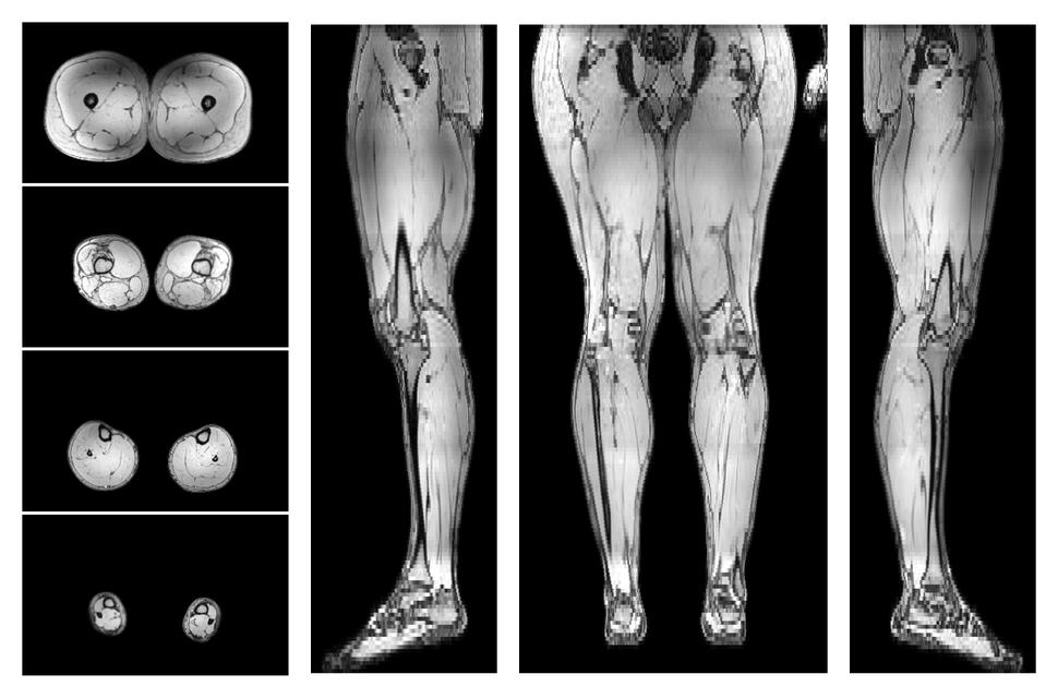 The out-phase image of the dixon reconstruction for water fat quantification.